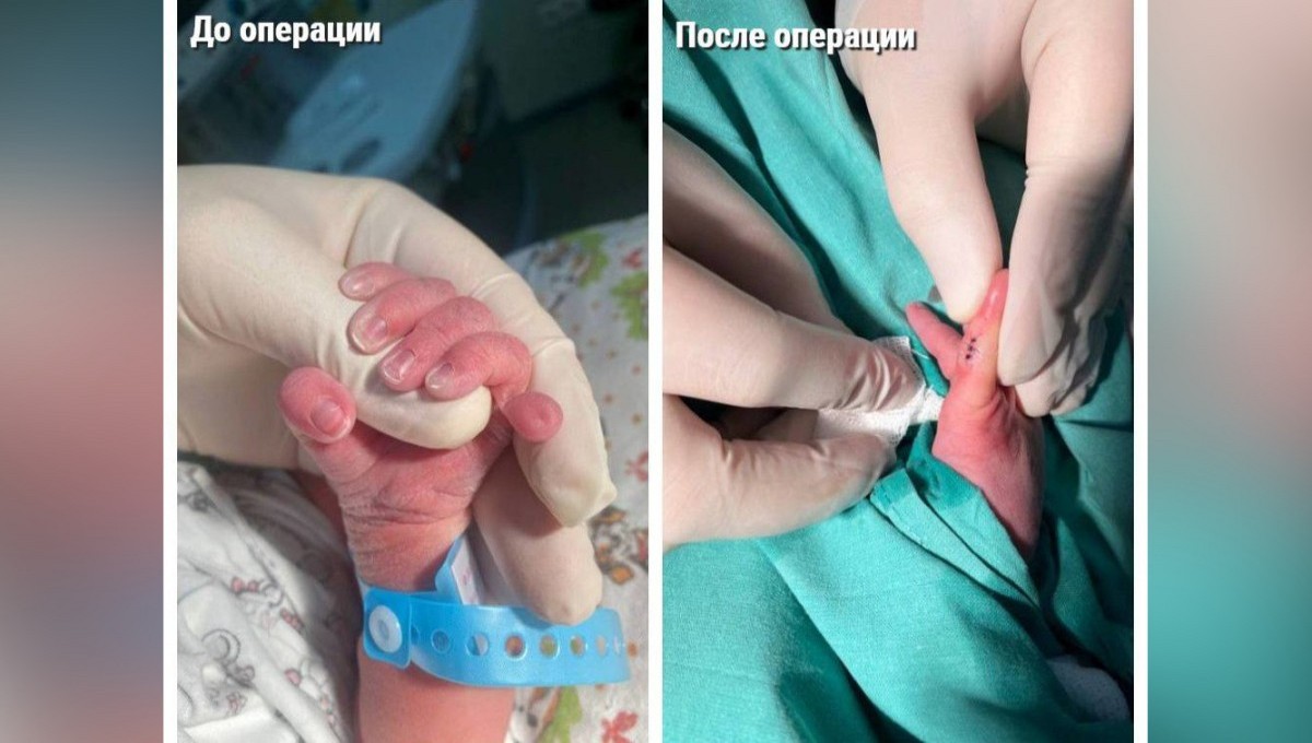 Подмосковные врачи удалили новорождённому шестой палец