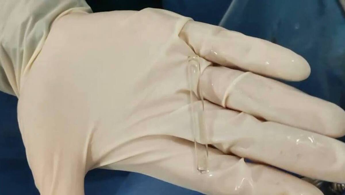 Пипетка оказалась в очень неожиданном месте у мужчины из Подмосковья